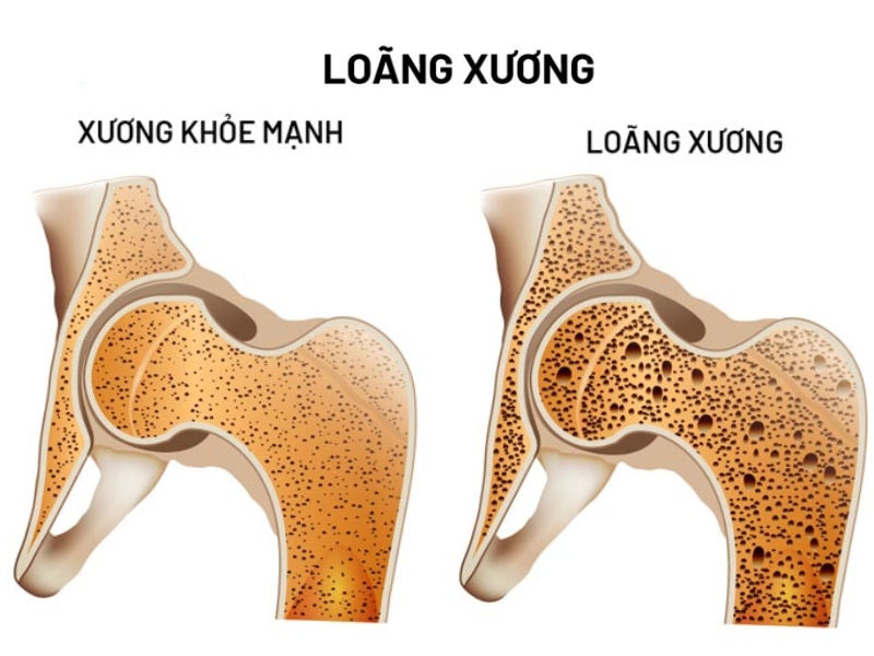 so-sanh-xuong-khoe-manh-loang-xuong